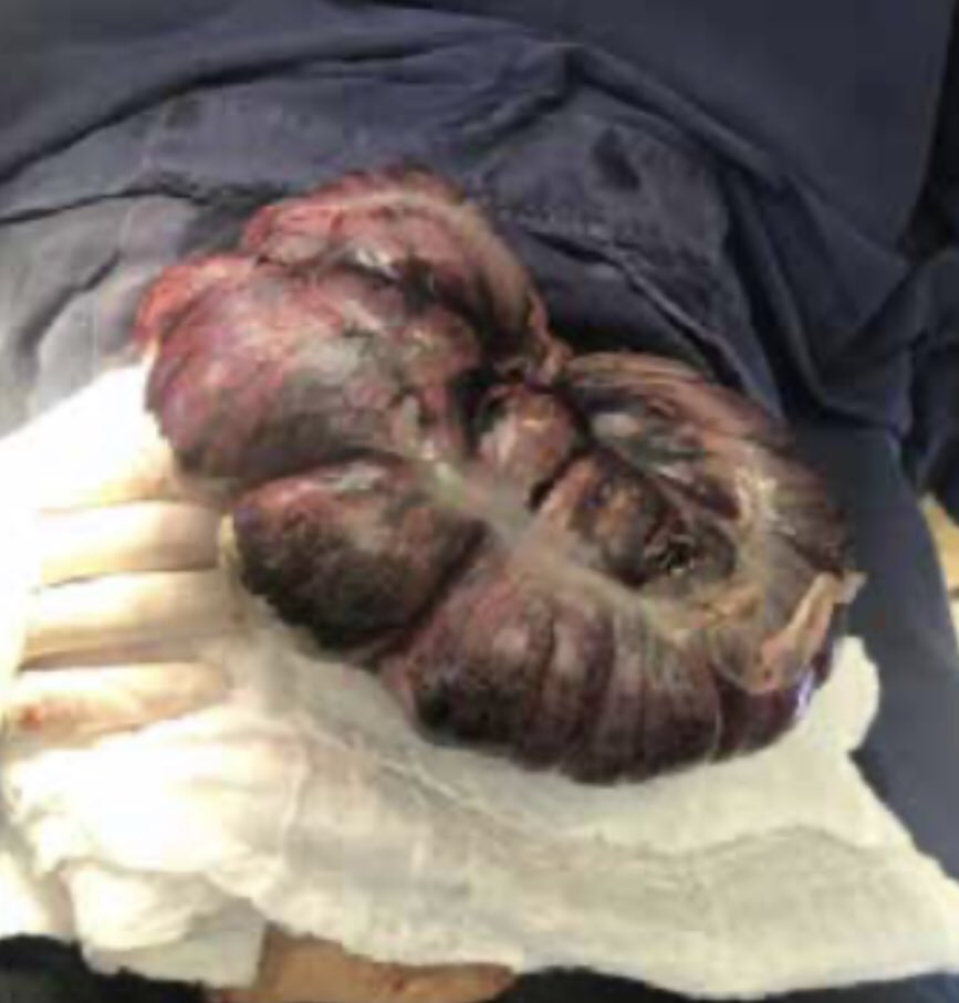 CiruAndes2's tweet photo. Image challenge by Dr @CiroPedraza: acute abdomen, unstable, laparotomy with this findings, what’s your diagnosis? #SoMe4Surgery #MedTwitter @topknife @pferrada1 @DrThawaba @juliomayol @SWexner @traumaicurounds @MISIRG1 @PipeCabreraV @salo75 https://t.co/uKI1e6CT33