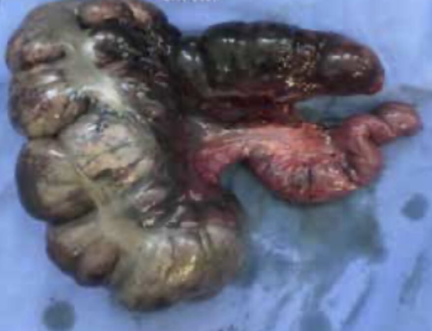 CiruAndes2's tweet photo. Image challenge by Dr @CiroPedraza: acute abdomen, unstable, laparotomy with this findings, what’s your diagnosis? #SoMe4Surgery #MedTwitter @topknife @pferrada1 @DrThawaba @juliomayol @SWexner @traumaicurounds @MISIRG1 @PipeCabreraV @salo75 https://t.co/uKI1e6CT33