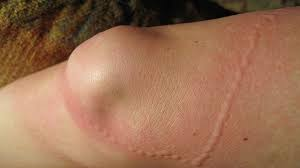 GTFNQ's tweet photo. Random Jellyfish Fact Part 3 

To aid a jellyfish sting: remove tentacles, vinegar or salty ocean water (not urine), sit in warm water for 45mins and if an allergic reaction occurs call 000. https://t.co/etOWSVC8Lb