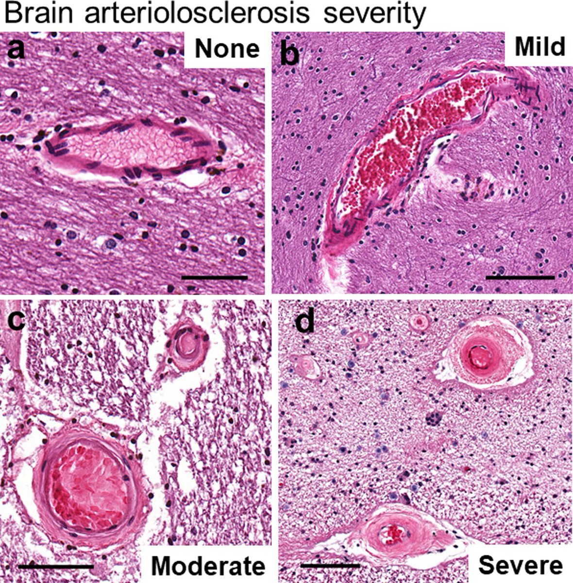 grinberg_t's tweet photo. fresh from the oven! Brain arteriolosclerosis and #dementia #actaneuropathologica. The ultimate review, organized by Peter Nelson with contributions of many #neuropathologists https://t.co/OGuCmJiTCY @UCSFmac @ISTAART @gerolab1 @wilcocklab @ErinAbnerPhD https://t.co/Rl1bySyn3R