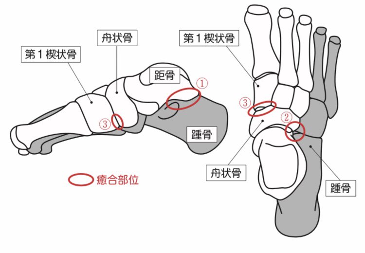 Pt Oshiro 沖縄の足部マニア Pt 小さなクリニックの主任pt 足根骨癒合症 マニアックな疾病ですが 当院では結構いらっしゃいます 距骨 踵骨間 踵骨 舟状骨関節 舟状骨 内側楔状骨間 の順に発生の頻度が高く 先天的疾患ですが無症候性 の場合が