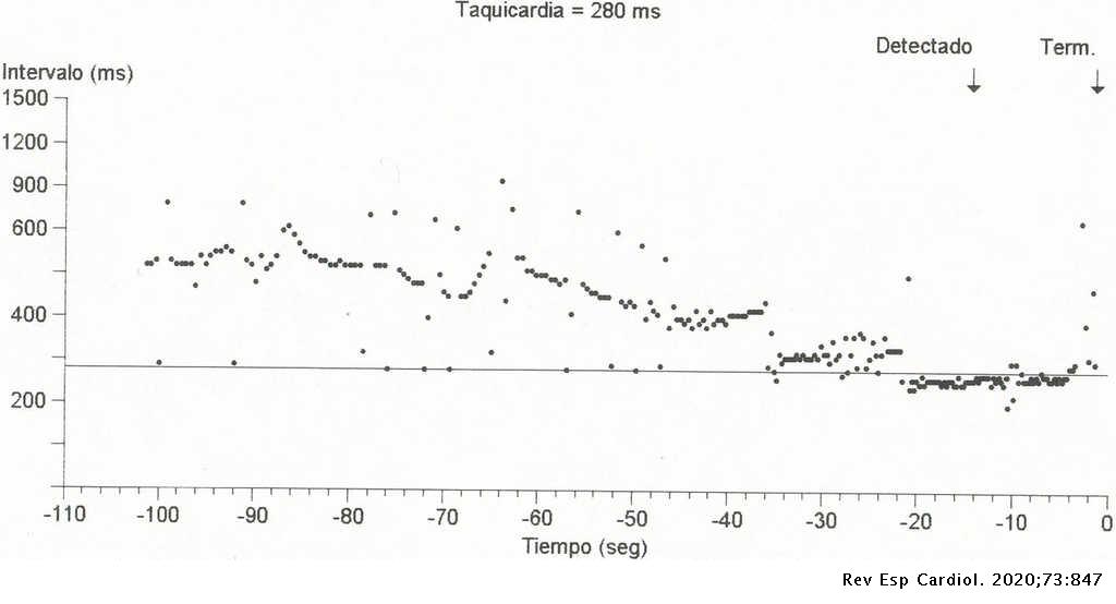 RevEspCardiol's tweet photo. ¿Te animas a participar en el #RetoECG del mes de Octubre?
¿Cuál es el D más probable?
#REC
- Taquicardia sinusal
- Taquicardia supraventricular conduida con aberrancia.
- Aleteo auricular preexcitado
- Taquicardia ventricular monomórfica sostenida
https://t.co/rh5suktPMH https://t.co/F798FWvMTi