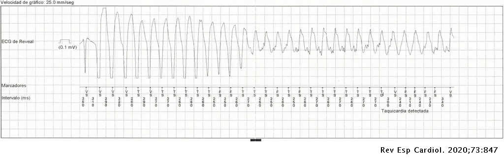 RevEspCardiol's tweet photo. ¿Te animas a participar en el #RetoECG del mes de Octubre?
¿Cuál es el D más probable?
#REC
- Taquicardia sinusal
- Taquicardia supraventricular conduida con aberrancia.
- Aleteo auricular preexcitado
- Taquicardia ventricular monomórfica sostenida
https://t.co/rh5suktPMH https://t.co/F798FWvMTi