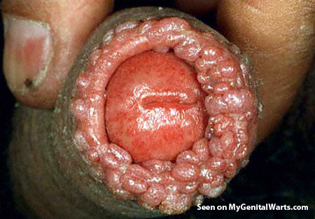WorldChannelCe1's tweet photo. if the disease is left untreated for more than a week this is the result, we urge you to get treatment as soon as the symptoms appear or as soon as you suspect you might have TEEN PUTREFACTION

#teencorrode
#putrefaction
#TP1 https://t.co/CqyOigkw7E