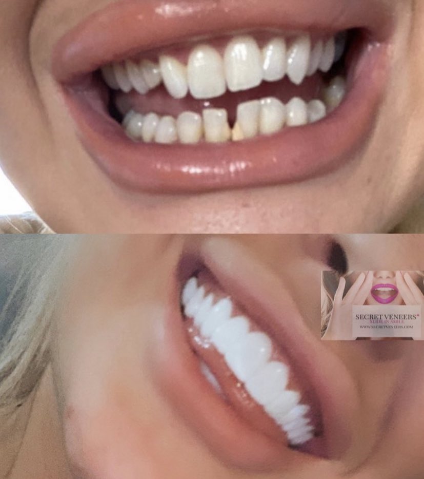 1 Clip In Veneer Experts Transformation Alert Our Clip On Veneers Are A Great Cost Effective Way To See How You Would Look In Veneers Before Spending Secretveneers 1 Clip In Veneer Experts Transformation Alert Our Clip On Veneers Are A Great Cost Effective Way To See How You Would Look In Veneers Before Spending Secretveneers