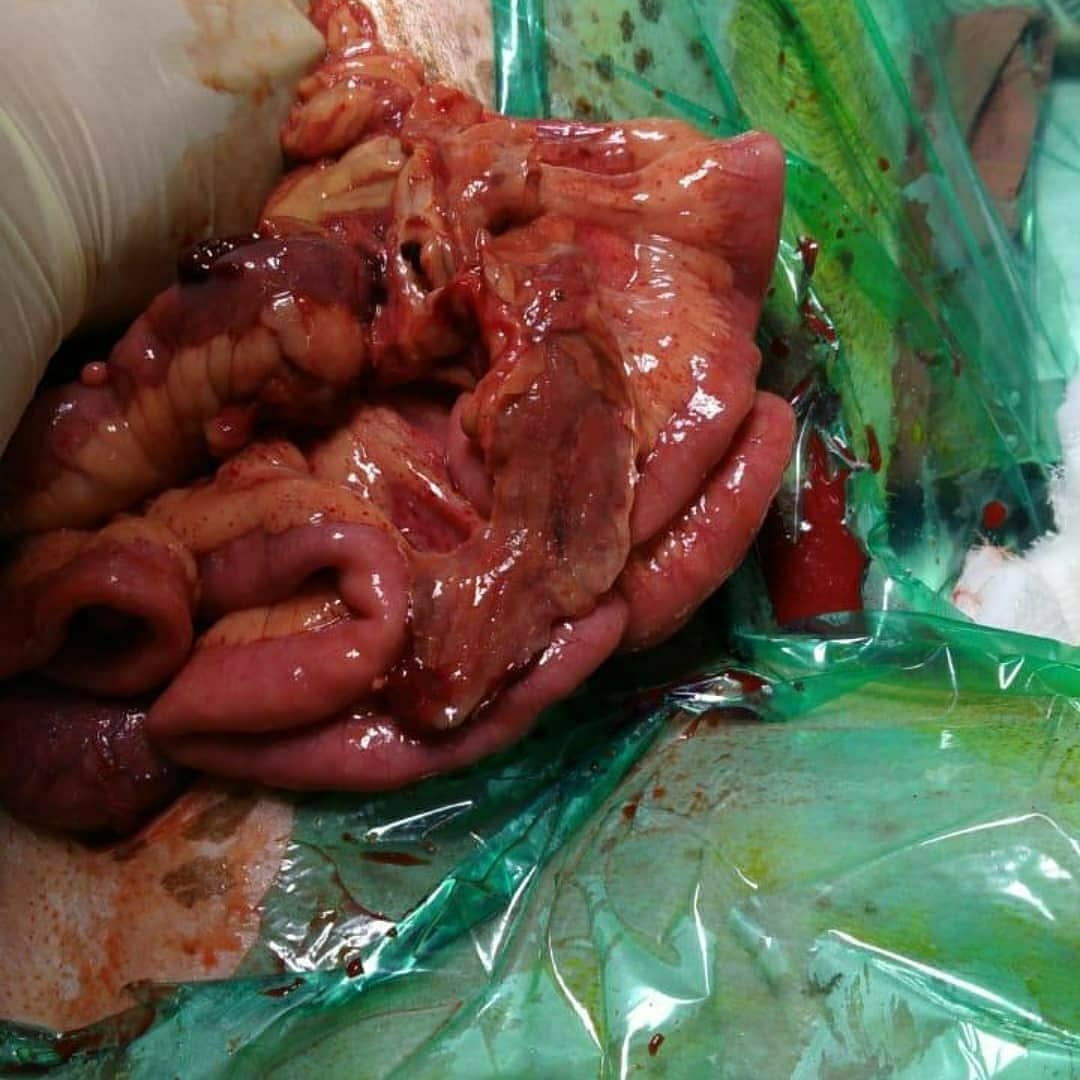 _margee_'s tweet photo. During emergency treatment, an 11-inch wooden rod was found, inserted in her vagina which left her internal organs destroyed.
Noorie had to be slit open chest down to her genitals during surgery. https://t.co/nrtWU3dtLt