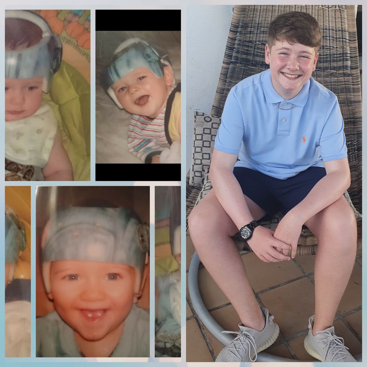 Meet Charlie, who started his treatment back in 2006

“Sandy and Steve treated my son Charlie Mcallister back in 2006 for plagiocephaly and brachycephaly. Charlie had one of the best results Sandie and Steve said. He is nearly 15 and 5ft 9, a lovely young man.

 #flatheadsyndrome