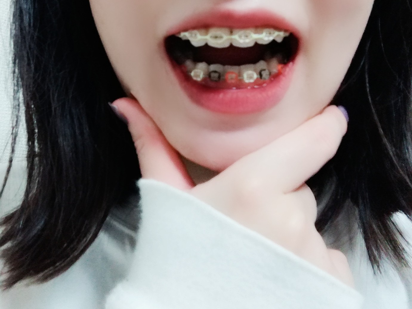 ダリッタ 歯茎にドリルで穴開けられて口の中縫われて糸がピンピン出てるし血だらけになった つーわけでインプラント2本ぶちこんで矯正のゴムはハロウィン仕様にした かっけーだろ T Co L90a2adncl Twitter