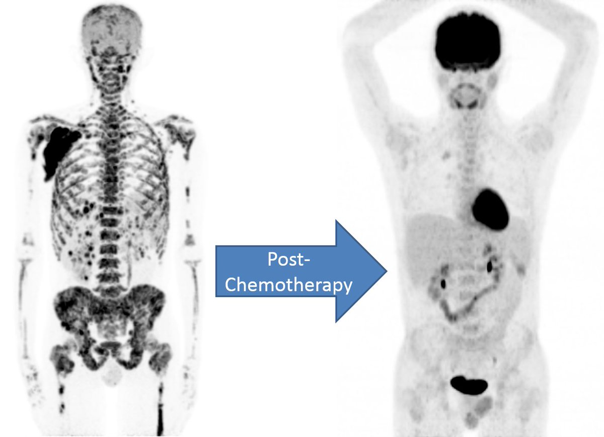 24yo Male, 3w of fever and visceral crisis
🔬Burkitt Lymphoma
☢️Staging PET w/ massive bone, nodal and visceral disease.
☠️no brain uptake
☣️Complete metabolic response  

Striking images showing cancer “cure”! OncoHematology often brings drops of good news through our reports.