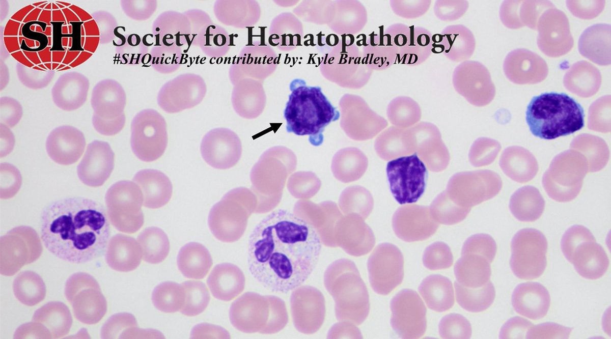 #SocHemepath #SHQuickbyte 

T-cell prolymphocytic leukemia is a rare, aggressive leukemia. 

Cells often show cytoplasmic blebs on the blood smear (arrow) 

CD4+ (60%), CD4+CD8+ (25%), CD8+ (15%) TCL-1 (usually +)

inv(14) is seen in 80% of cases

#hemepath #leusm #lymsm