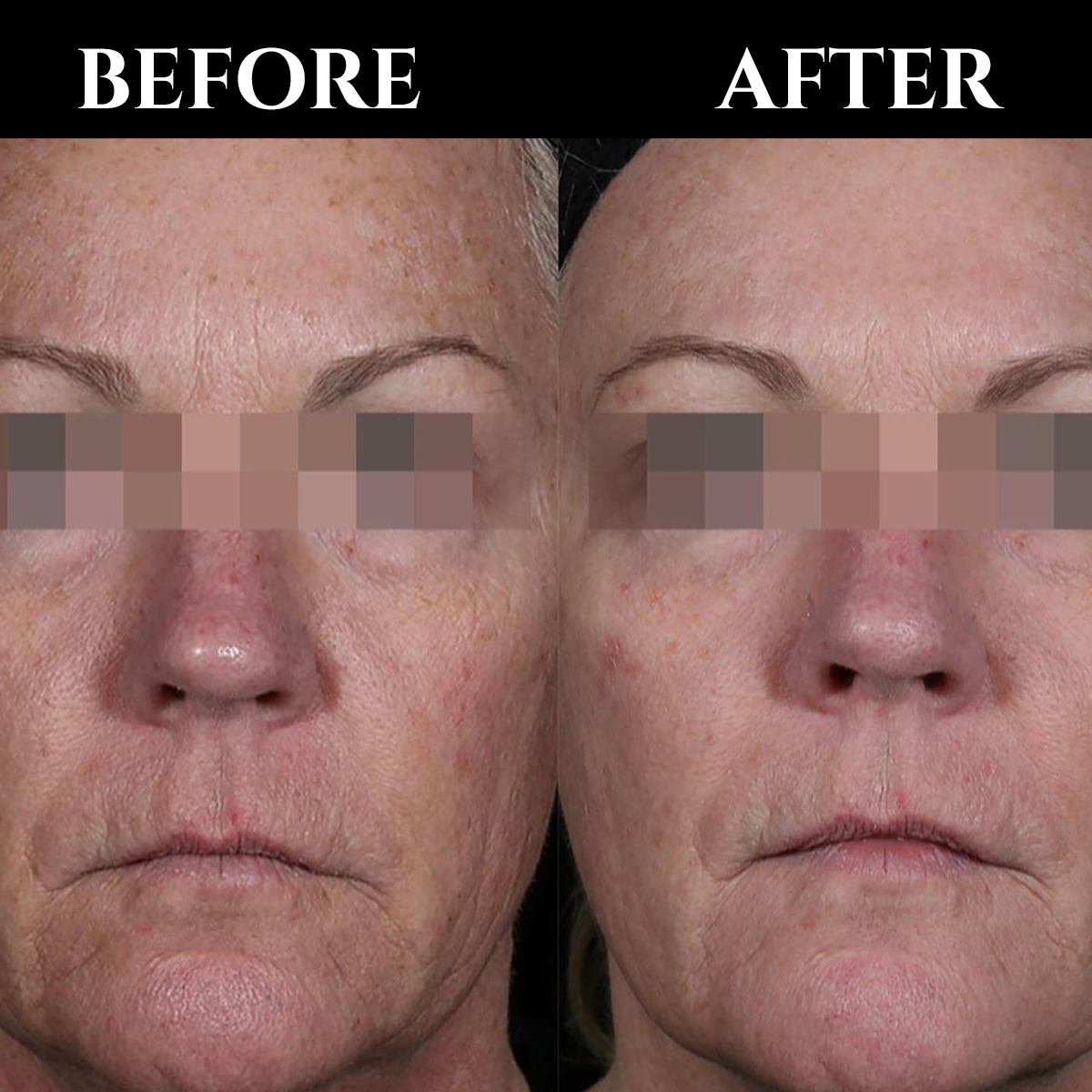 ✨How can we get a rejuvenated skin? Let's talk about rejuvenating & revitalizing. Check out this before and after with 3 PICO GENESIS TREATMENTS#CuteraAnz Credits: cutera.anz #Cutera #beauty