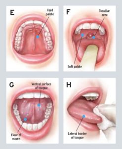 The National Cancer Institute outlines the necessity for oral cancer screenings while in good health. If detected early, the cancer may be much easier to treat. bit.ly/2ITHuVL