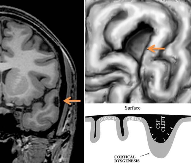 EpilepsiaRuber's tweet photo. El signo del “hoyuelo” consiste en la presencia de un hundimiento focal del córtex como consecuencia de una malformación subyacente. Identificar hallazgos indirectos de lesiones sutiles es fundamental en la evaluación de los pacientes con epilepsia focal refractaria.
#Epiteca https://t.co/CufbEqFSX9