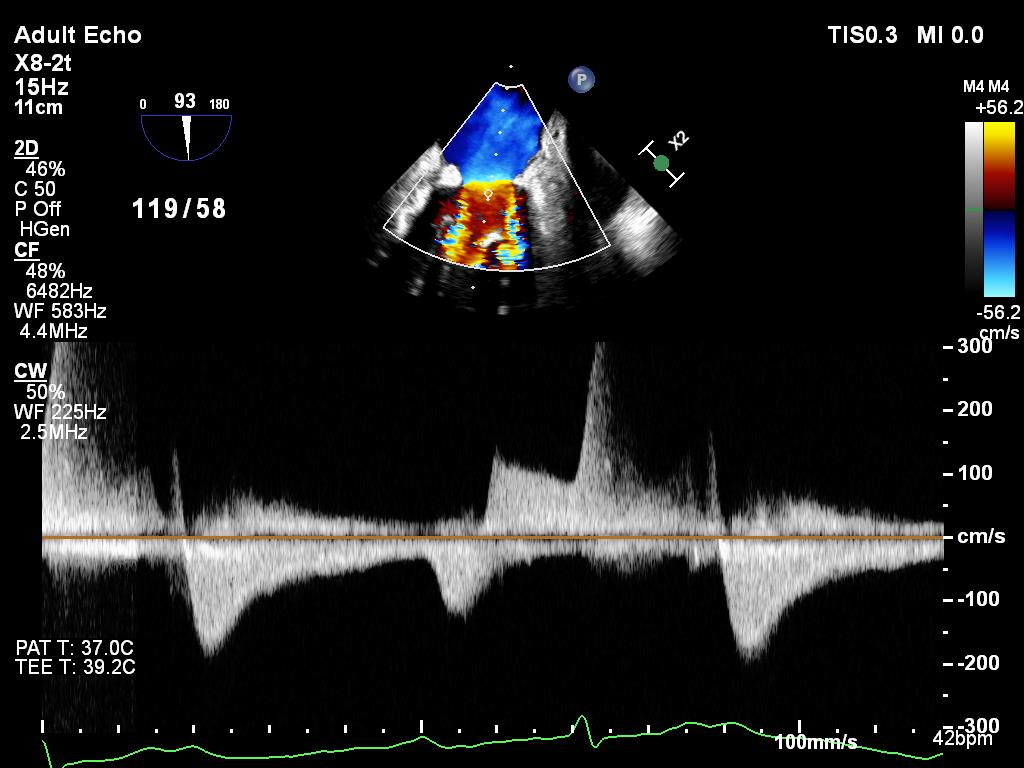 As a bonus, see if you can label the continuous wave Doppler tracing across the mitral valve.19//