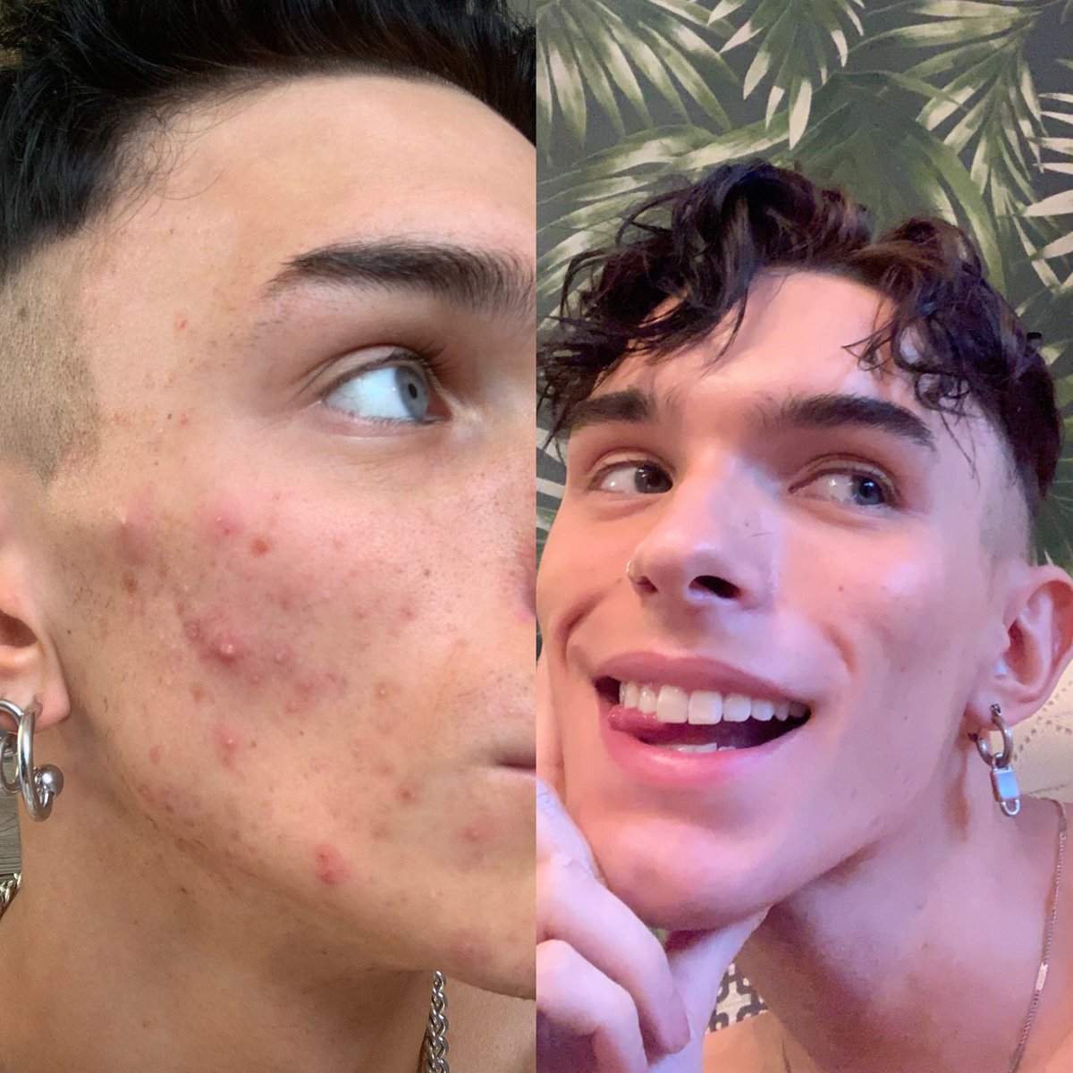 smintyd's tweet photo. My skin has always been one of my biggest insecurities but 2 months on antibiotics for my acne &amp; I already feel more confident than ever 🤍 https://t.co/93cYULgzFc