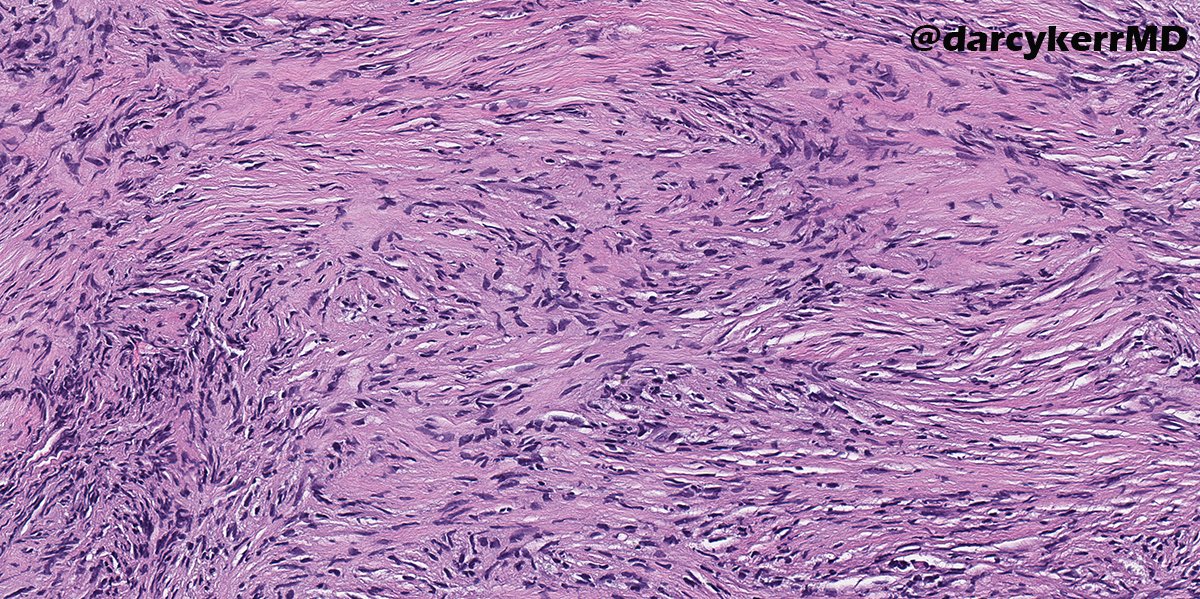 darcykerrMD's tweet photo. IHC is usually not *this* helpful in bone pathology -
Young woman with a femur lesion, mixed lytic and sclerotic with a narrow zone of transition. Any guesses on the key IHC stain here? Diagnosis? #BSTPath @JaylouVelez https://t.co/dPMtll7Dml