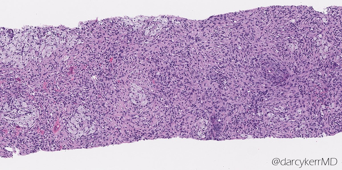 darcykerrMD's tweet photo. IHC is usually not *this* helpful in bone pathology -
Young woman with a femur lesion, mixed lytic and sclerotic with a narrow zone of transition. Any guesses on the key IHC stain here? Diagnosis? #BSTPath @JaylouVelez https://t.co/dPMtll7Dml