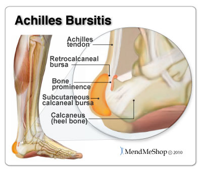 MendMeShop's tweet photo. The most common #bursa to be inflamed in the foot is the retrocalcaneal bursa (also referred to as the subtendinous #calcaneal bursa).  https://t.co/TtUo8wHACs #Achilles #mendmeshop #bursitis https://t.co/Itbi9sm4wa