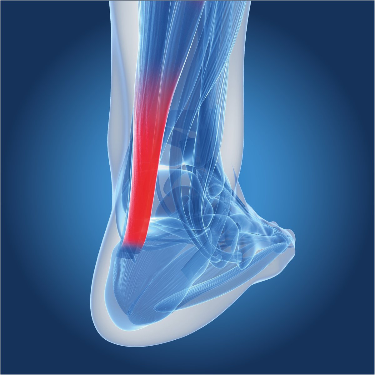 #AchillesTendinitis • A common condition that causes #pain along the back of the leg near the #heel. It connects your calf muscles to your heel bone and is used when you walk, run, and jump. Contact us to find out how #CustomisedOrthotics can hep alleviate pain.