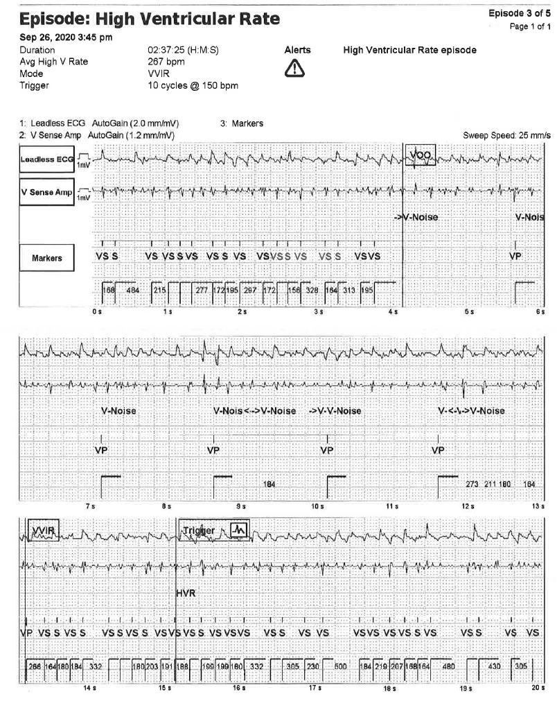 SergioPinski's tweet image. Patient comes with pacemaker implanted a few months ago elsewhere. These are the scary initial findings. What is going on in the EGM?
