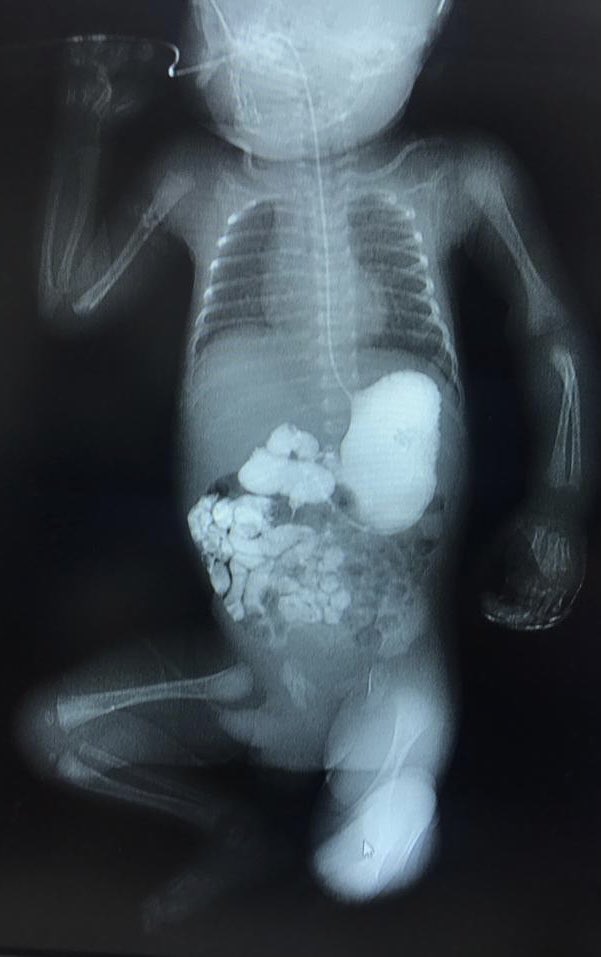 PediatricSurg's tweet photo. Most dreadful condition for a neonate ⚠️
What are the signs and symptoms of this condition which causes neonatal intestinal obstruction ?🆘 
🔑Hint: Late presentations will often undergo extensive bowel resection
#EverythingPediatricSurgery #SoMe4PedSurg #PedSurg #NeonatalSurgery https://t.co/DCgsVjXXWZ