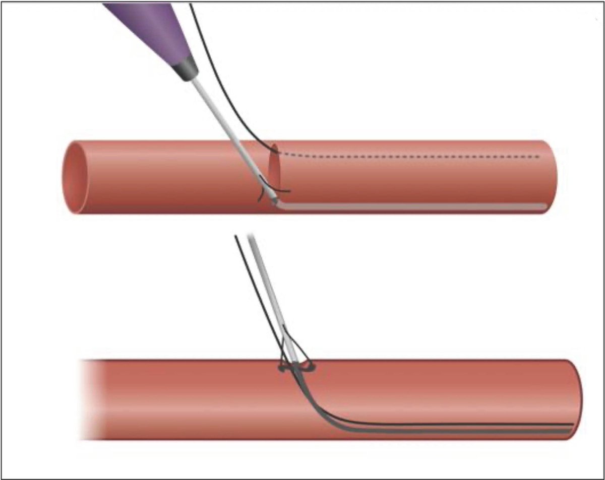 MyJSCAI's tweet photo. Large-Bore #Postclosure Technique w/ 2 ProGlide Devices
-Wire large-bore sheath w/ two 0.035" wires
-Deploy 2 ProGlide devices at +30 & -30 degrees
-Series of 22 successful cases
https://t.co/wr52y1YkcW
Follow @CCIJournal, https://t.co/oEQYGH7lGw
Official Journal of @SCAI https://t.co/NLob4vtbln