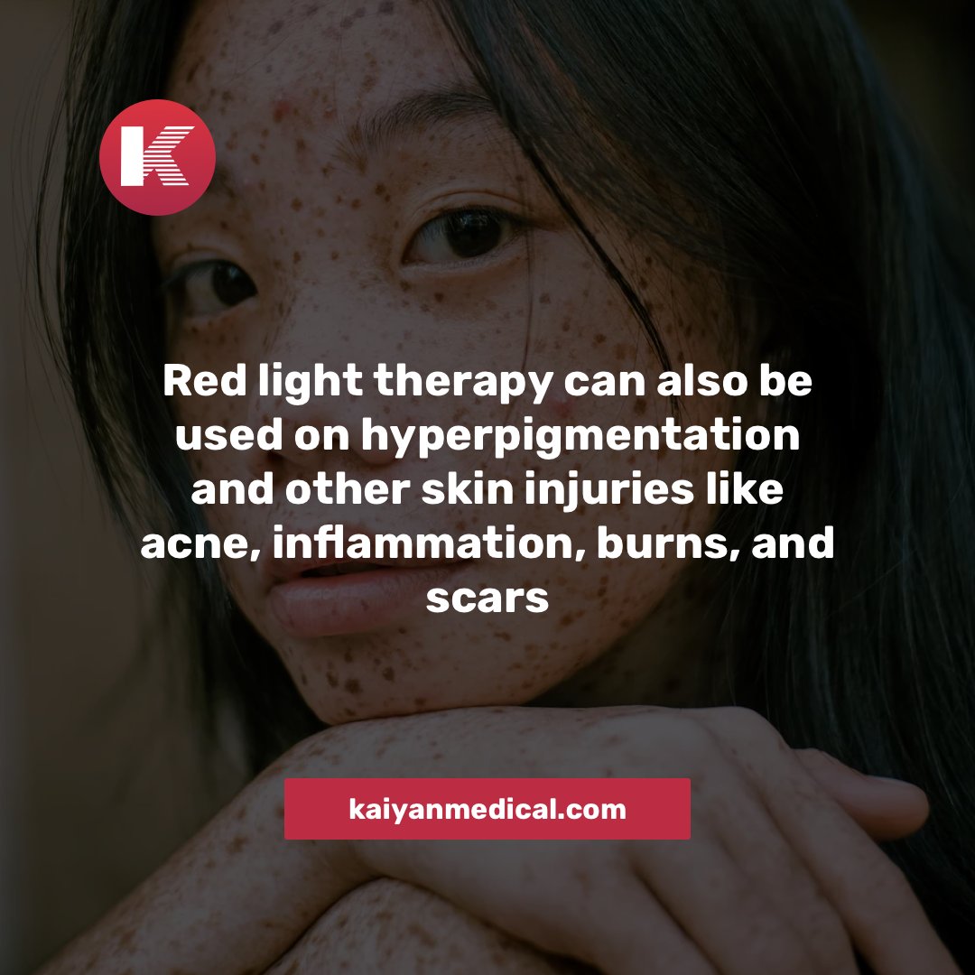MedicalKaiyan's tweet image. Hyperpigmentation can be one or multiple skin patches or spots that appear much darker than your skin color. It is a cell mutation caused by changes in hormones, an injury like sunburn, acne, or inflammation.

#hyperpigmentation #redlight #kaiyan #kaiyanmedical