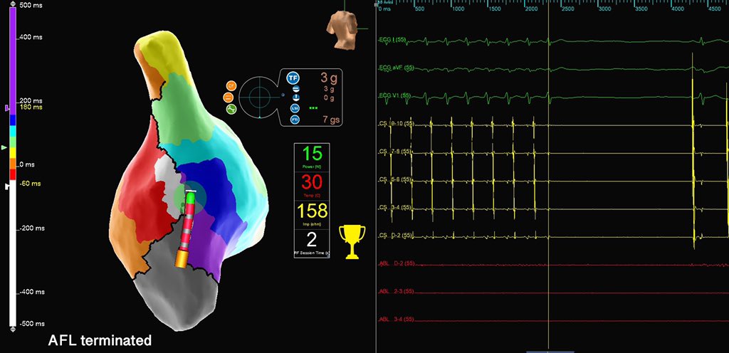 murphy_lzy's tweet photo. Do you eliminate gap on crista terminalis?
Normal size RA post CTI ABL, presented paroxysmal AF/AFL and frequent PACs.
2s RF terminated flutter.
#AbbottEmp #EPeeps @EricTSLim @JeffZhanghk2017 @sabarisarav @Hapa_EP @forkknifecab_EP @ep_nerd @szufski1 @AbbottCardio https://t.co/pcb0jb36vf
