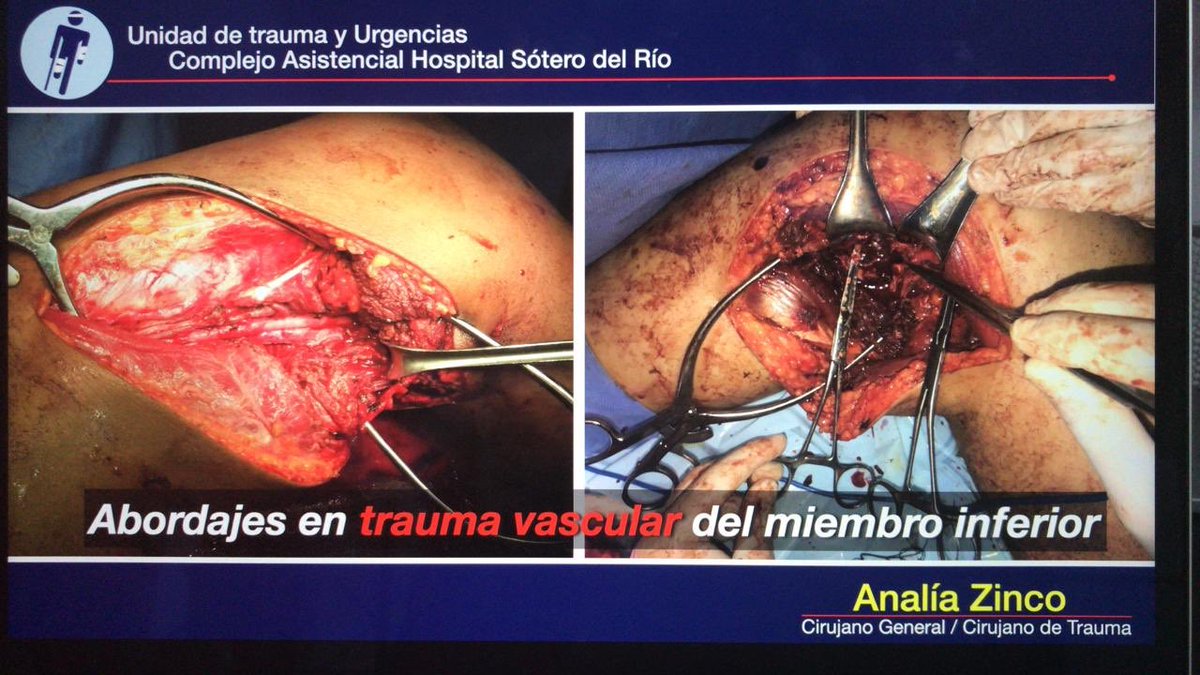 Hoy en nuestra reunion clinica, “Abordajes en trauma vascular de extremidad inferior” con <a href="/AnaliaZinco/">analia.zinco</a> 19:00 hora 🇨🇱 por zoom: us02web.zoom.us/webinar/regist… @Cirbosque @SOCICH_ <a href="/SimulacionUC/">SimulacionUC</a> <a href="/AmCollSurgeons/">American College of Surgeons</a> <a href="/gaboescvi/">Gabriel Escalona Vivas</a> <a href="/ottolinopablo/">Pablo Ottolino</a> <a href="/Me4Trauma/">SoMe4Trauma</a> no te lo pierdas!