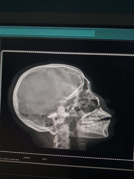 _serinet's tweet photo. A skincare therapist known as Favour grey miraculously survived despite having a bullet lodged in her head for 5 days.
#Desmond #EndBadGovernmentinNIGERIA #leadership https://t.co/S23smrquFK