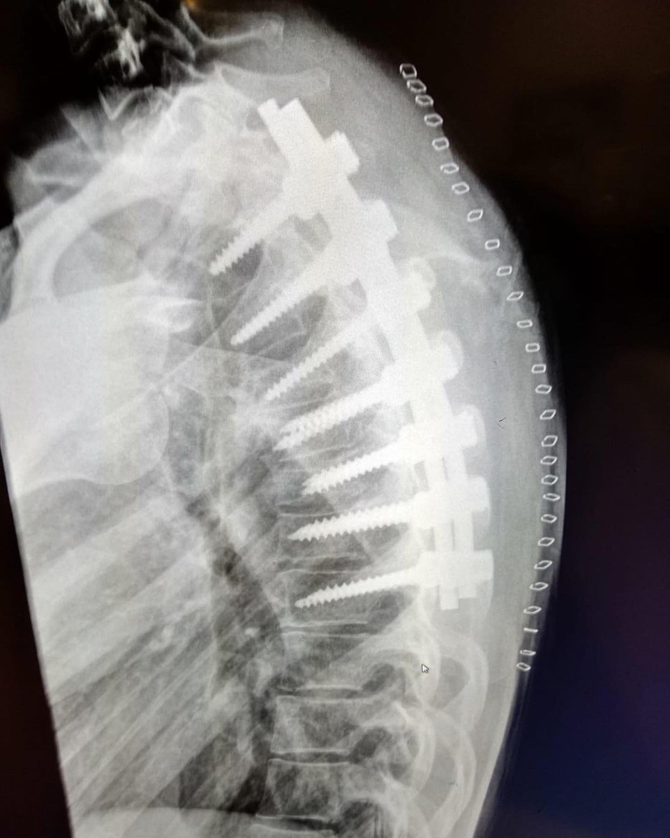 AnaCarrasco_22's tweet photo. I have hesitated to publish these pictures of my back after the operation, I upload them above all to enhance the work of Dr. Ubierna and her team, who thanks to their work in a few months I will be fit again! By the way, tomorrow we'll explain the plans for 2021. Stay tuned!😄🔜 https://t.co/DKtmyFJuE6