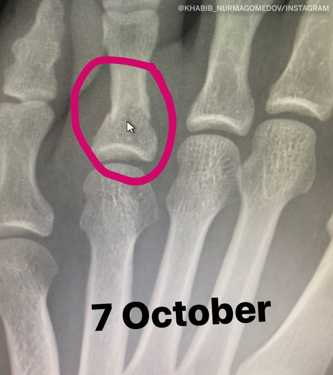 ESPN MMA on Twitter: "Khabib posted an X-ray of his broken toe from Oct. 7,  two weeks before he would compete at #UFC254 (via @TeamKhabib)  https://t.co/k3FAPeHRVz" / Twitter