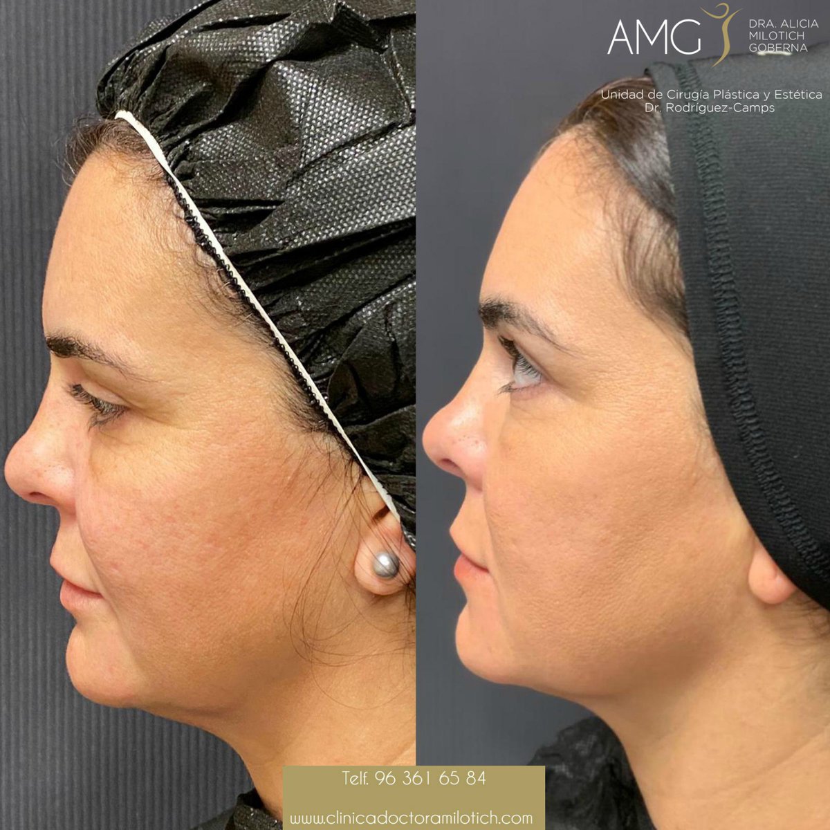 DraMilotich's tweet photo. En estas fotos podemos observar el tratamiento de rejuvenecimiento en una paciente de 44 años con #ácidohialurónico.
Se le realizó un soporte de tercio medio facial, tratamiento de #ojeras, #surconasogeniano, #lineamandibular y #mentón. https://t.co/sgWw246dln