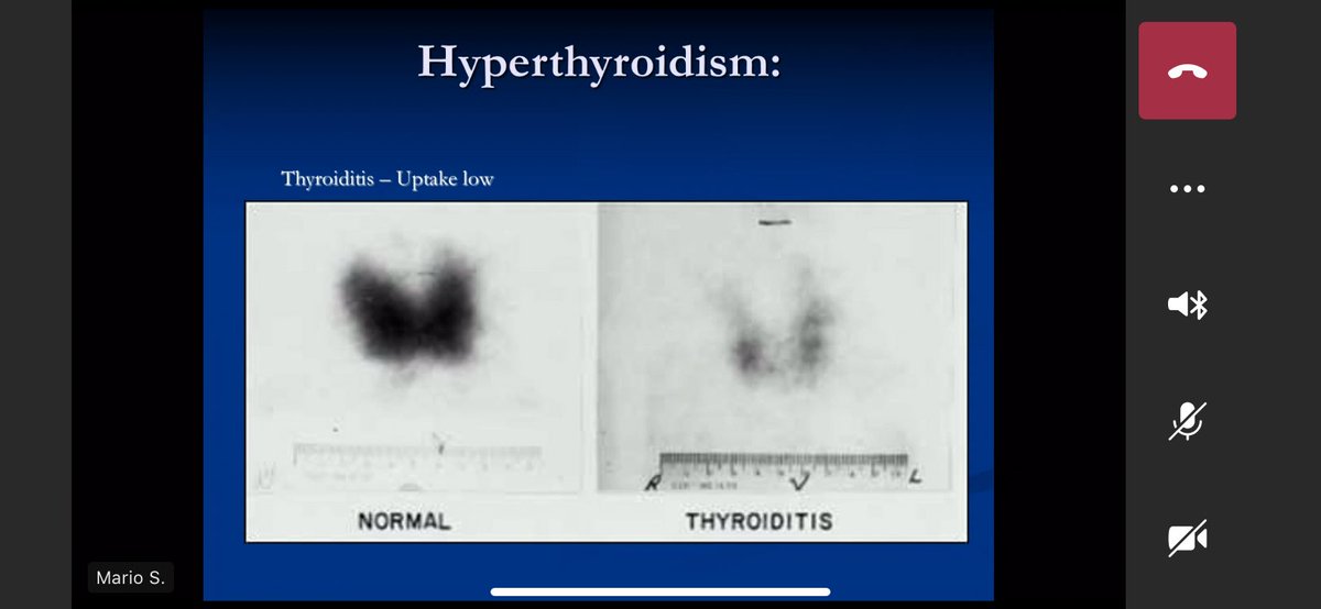More on hyperthyroidism approach!  #meded