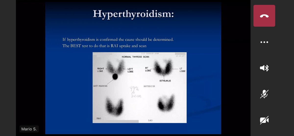 Hyperthyroidism approach - leverging radioactive iodine scan to differentiate causes.Graves - will give diffuse and nice uptake.Thyroiditis - will not show good uptake.