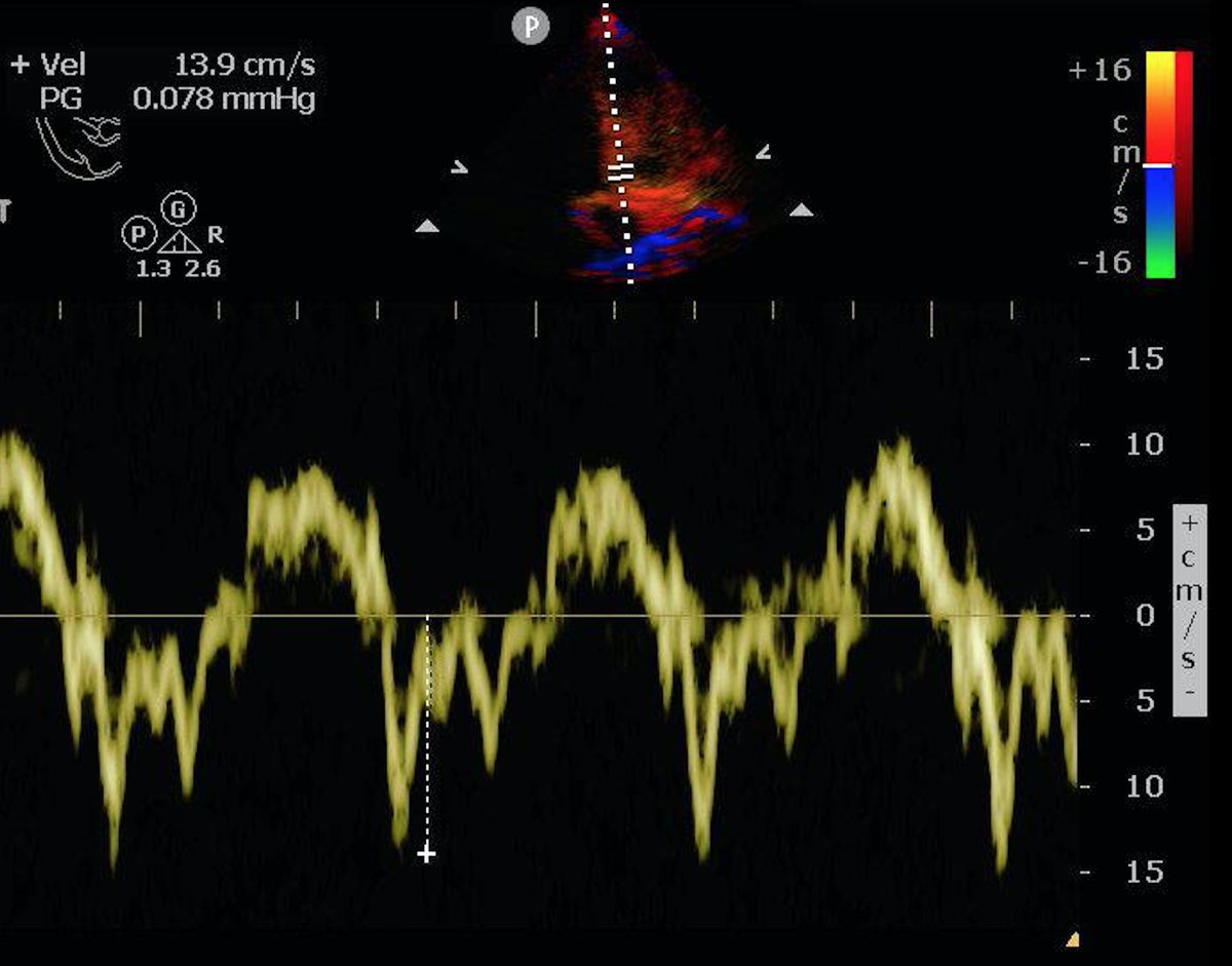 So back to the cardiac  #POCUSSome Doppler was shot, E and e’ waves recorded.E around 120, maybe higherE’ around 12-15 Making the E/e’ range come out around 8-109/20