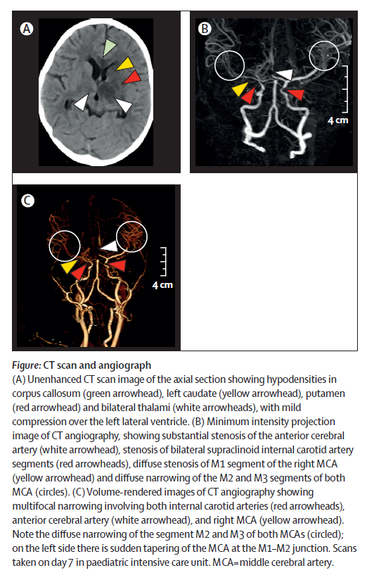 LancetChildAdol's tweet photo. New Case report: #COVID19 associated arterial ischaemic #stroke and #MISC in a 9-year-old girl in India

https://t.co/ukkOTtROMH #PIMSTS https://t.co/Mud2BCqkT0