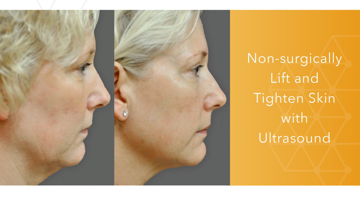 drpavlou's tweet photo. Ultherapy now available at Skin Technique! The ONLY FDA-cleared, non-invasive procedure that lifts the neck, chin and brow, and improves lines and wrinkles on the upper chest.
#ultherapy https://t.co/aI5avlqgGm