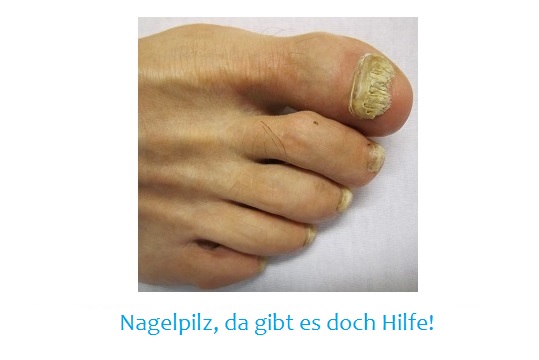 Den häßlichen Nagelpilz werden Sie nur los, wenn Sie ihn konsequent bekämpfen!
die-fussexperten.de/nagelpilz/
