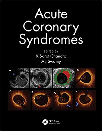 😁 Acute Coronary Syndromes 1st Edition PDF 2021 @ bit.ly/3e4PdA5 👈
#coronarymicrovasculardysfunction #Cardiology