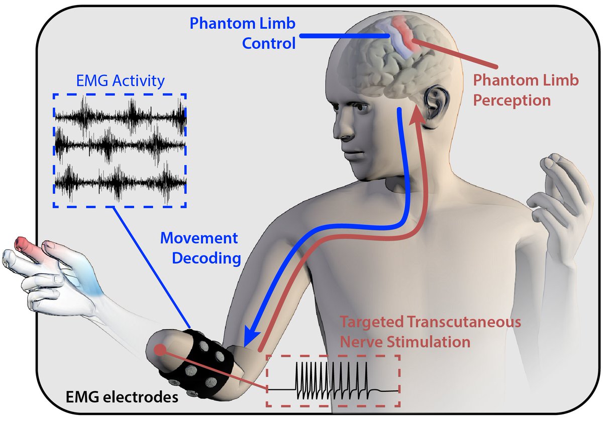 Our paper on sensory stimulation to enhance phantom limb perception and control is out now in J Neural Eng. We found that in individuals with arm amputation, a heightened sense of the phantom hand led to improved movement decoding and prosthesis control. 
iopscience.iop.org/article/10.108…