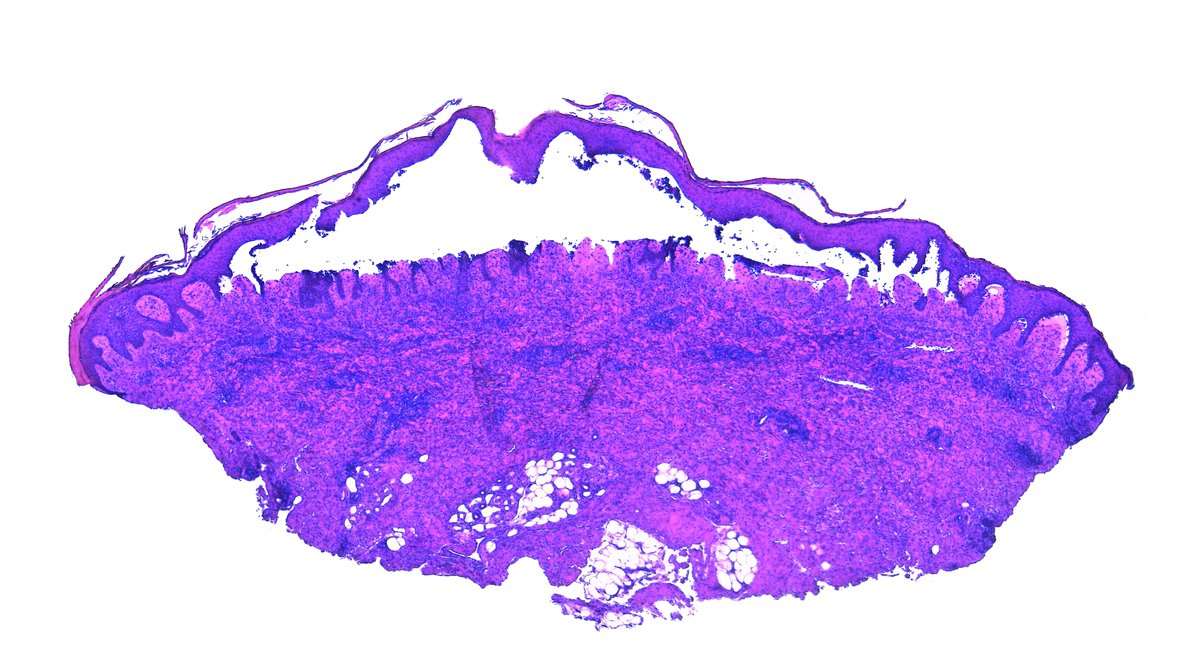 Patholwalker's tweet image. Bullous pemphigoid. #Pathologist #Pathology #Dermpath