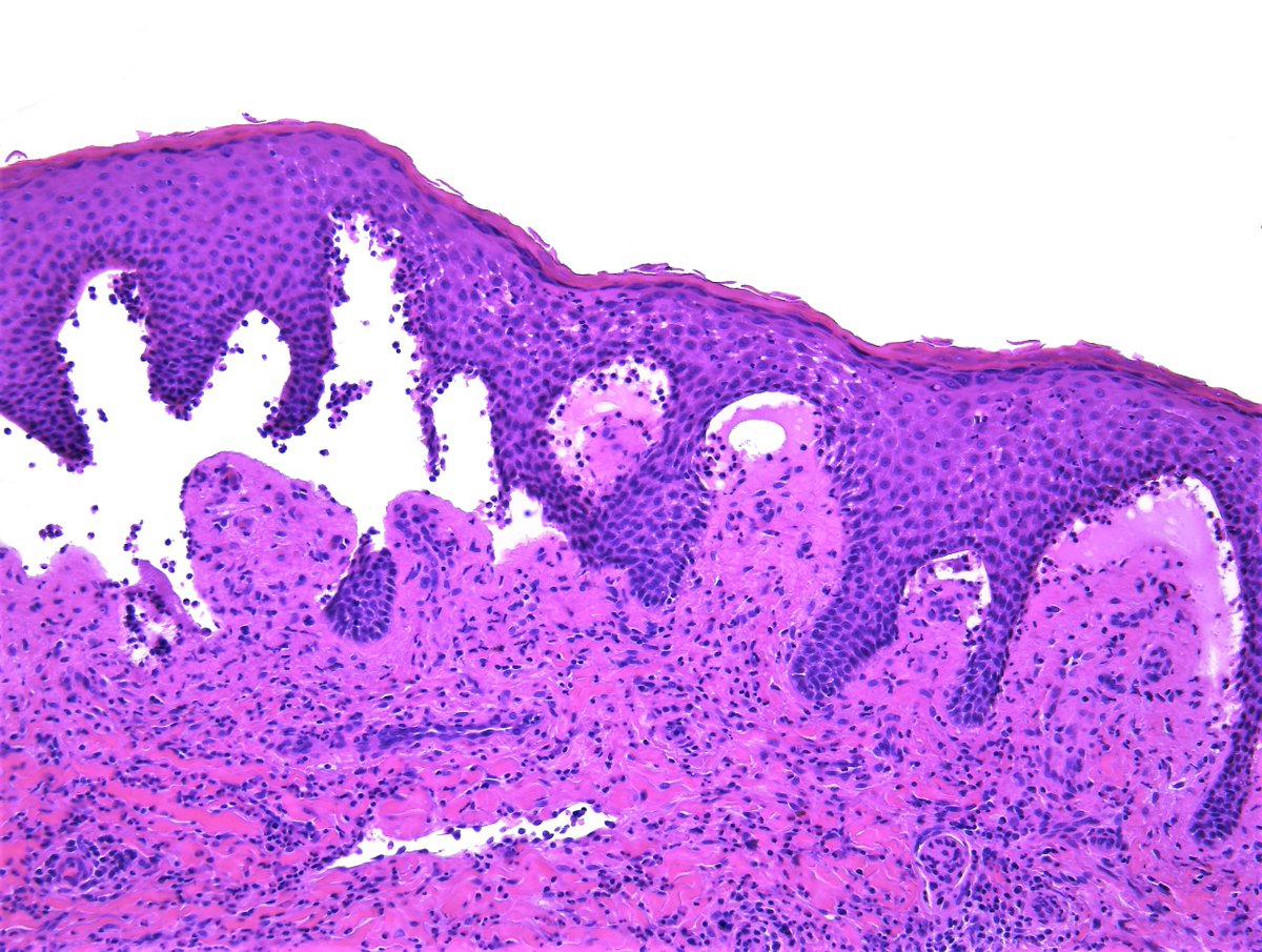 Patholwalker's tweet image. Bullous pemphigoid. #Pathologist #Pathology #Dermpath