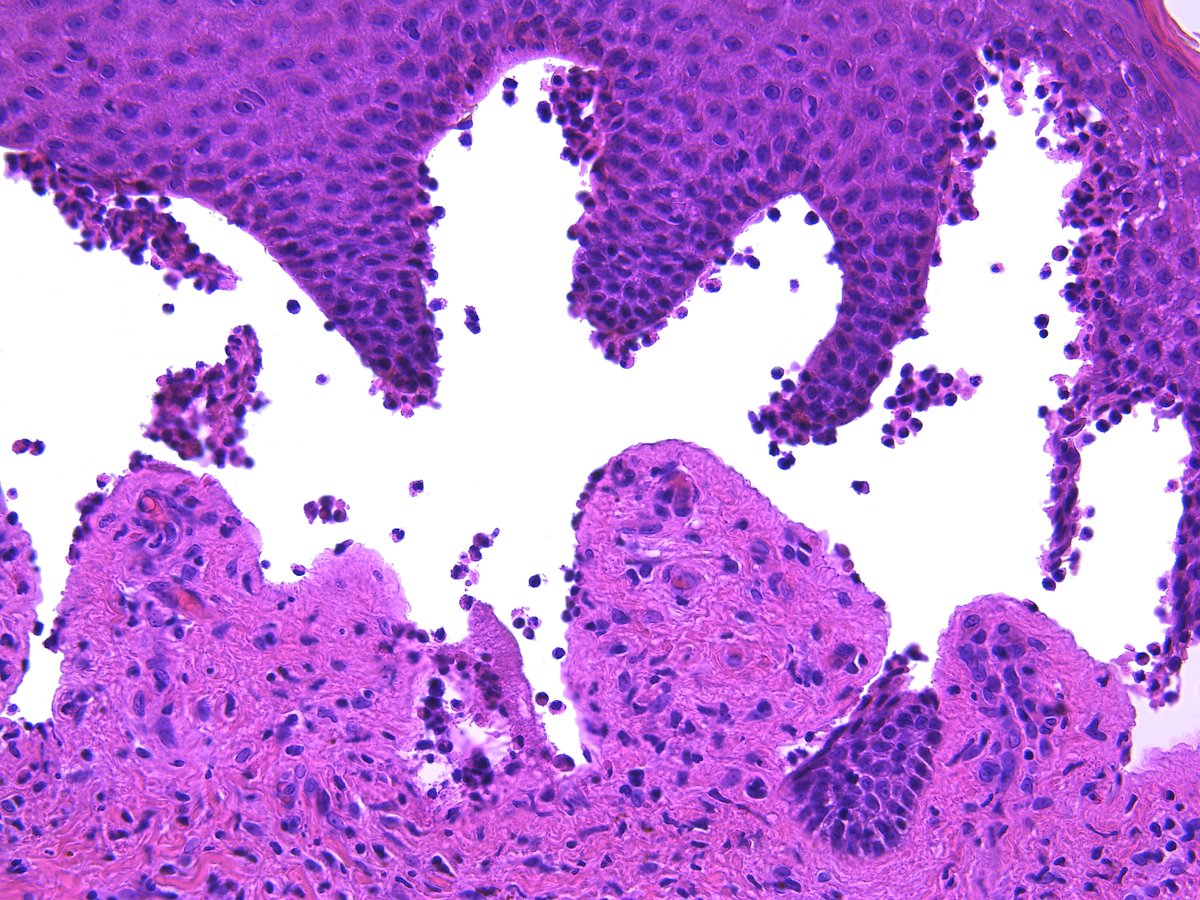 Patholwalker's tweet image. Bullous pemphigoid. #Pathologist #Pathology #Dermpath