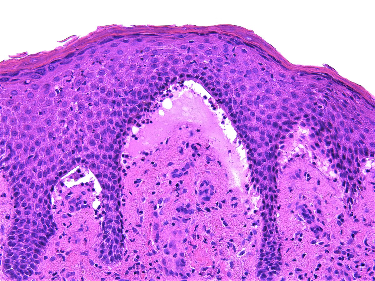 Patholwalker's tweet image. Bullous pemphigoid. #Pathologist #Pathology #Dermpath