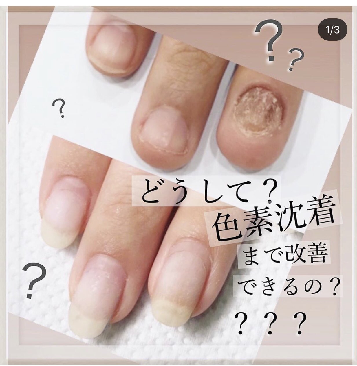 新潟爪育成ネイルサロン Venus そういえば 新潟県初のメディカルネイルプランナーとなりました 深爪 トラブル爪に対応しております 爪にお困りの事がございましたら お気軽にご連絡下さい フィルインにも対応しております 深爪育成 深爪矯正