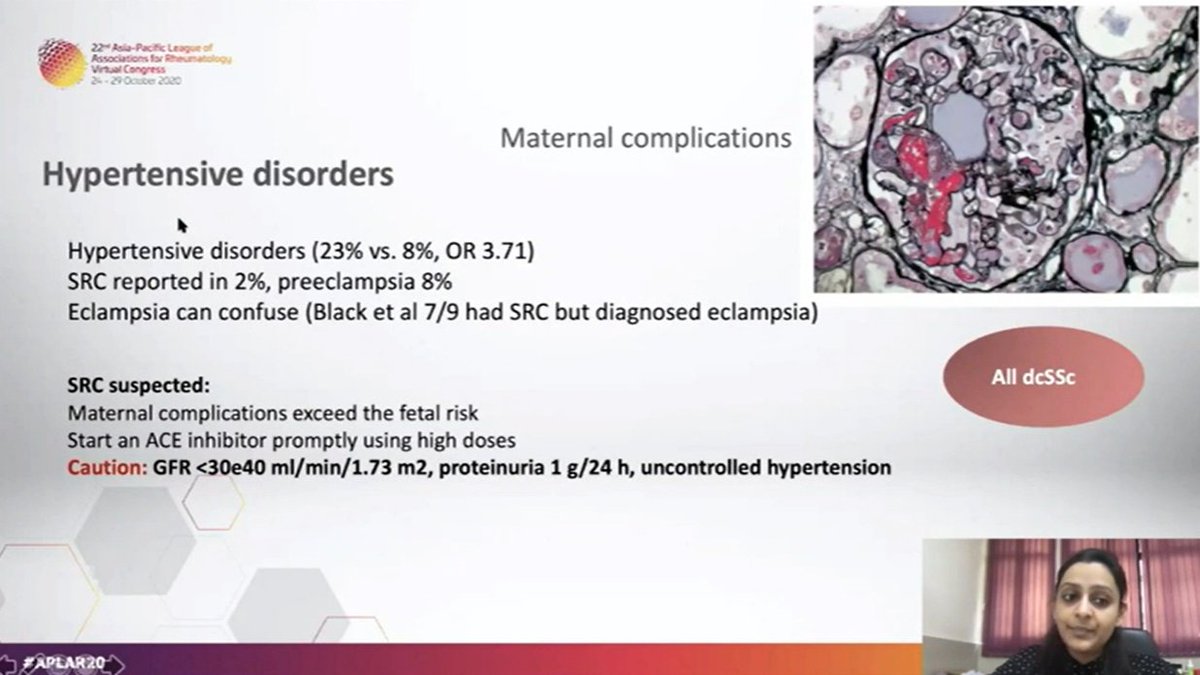 RHEUMarampa's tweet photo. Systemic #sclerosis is a very challenging disease and pregnancy should always be planned. Maternal complications like hypertensive disorders include #eclampsia &amp; #scleroderma renal crisis @LatikaGupta_ #APLAR20 https://t.co/l0jCiIDJKF
