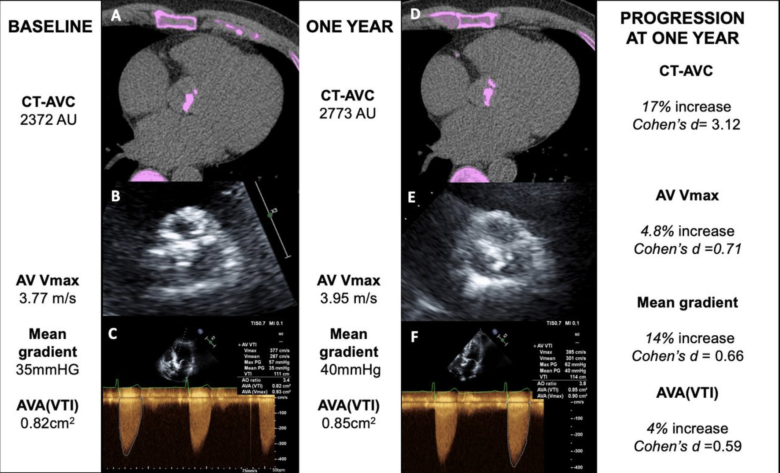 Heart Bmj On Twitter Computed Tomography Aortic Valve Calcium Scoring For The Assessment Of Aortic Stenosis Progression Heart Https T Co R1cmotsjd4 Https T Co T0domqxymj Twitter