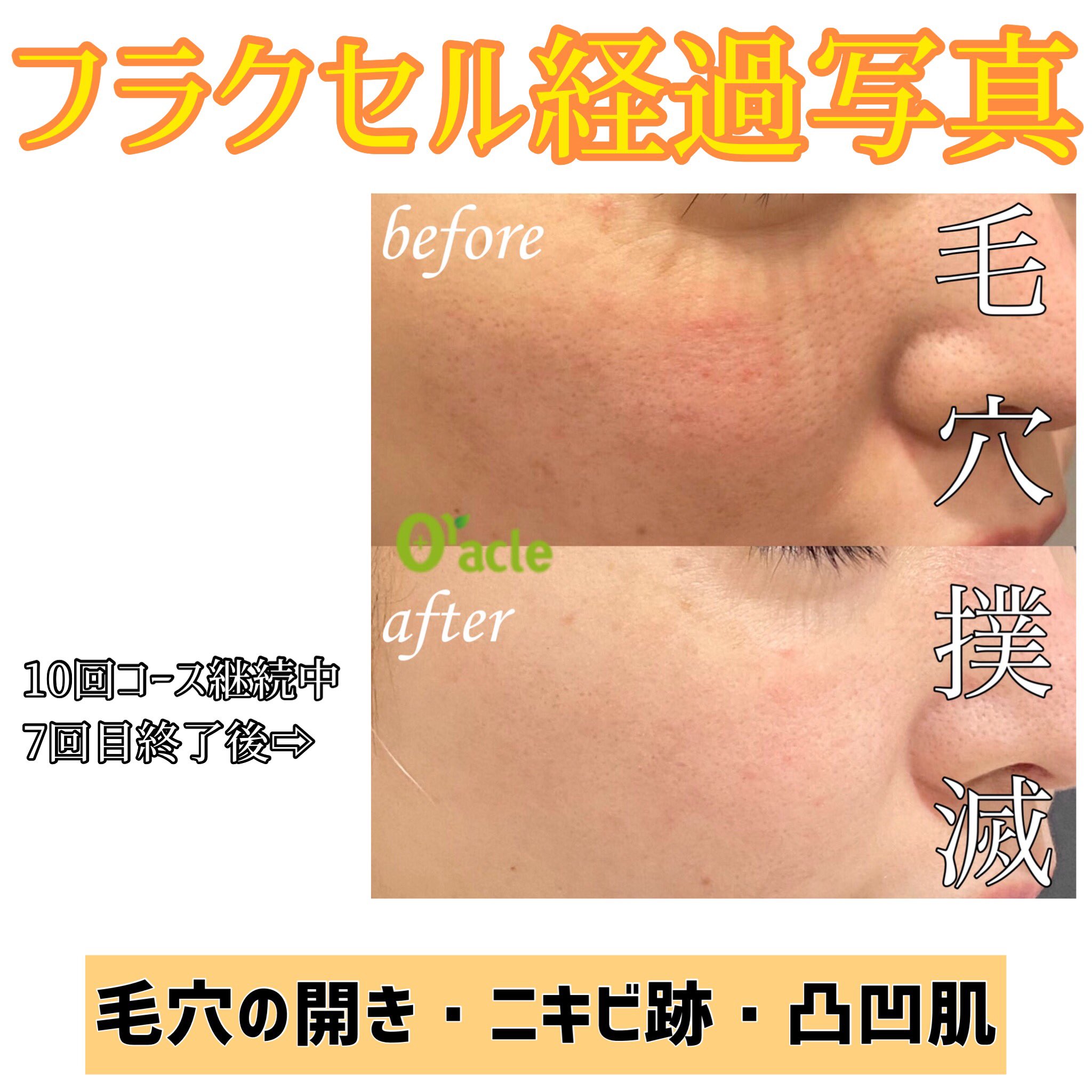 オラクル美容皮膚科 Twitterissa フラクセル 毛穴の開き ニキビ跡 頬の毛穴が目立たなくなりました T Co Qgkem8wc6i オラクル美容皮膚科 ニキビ 毛穴