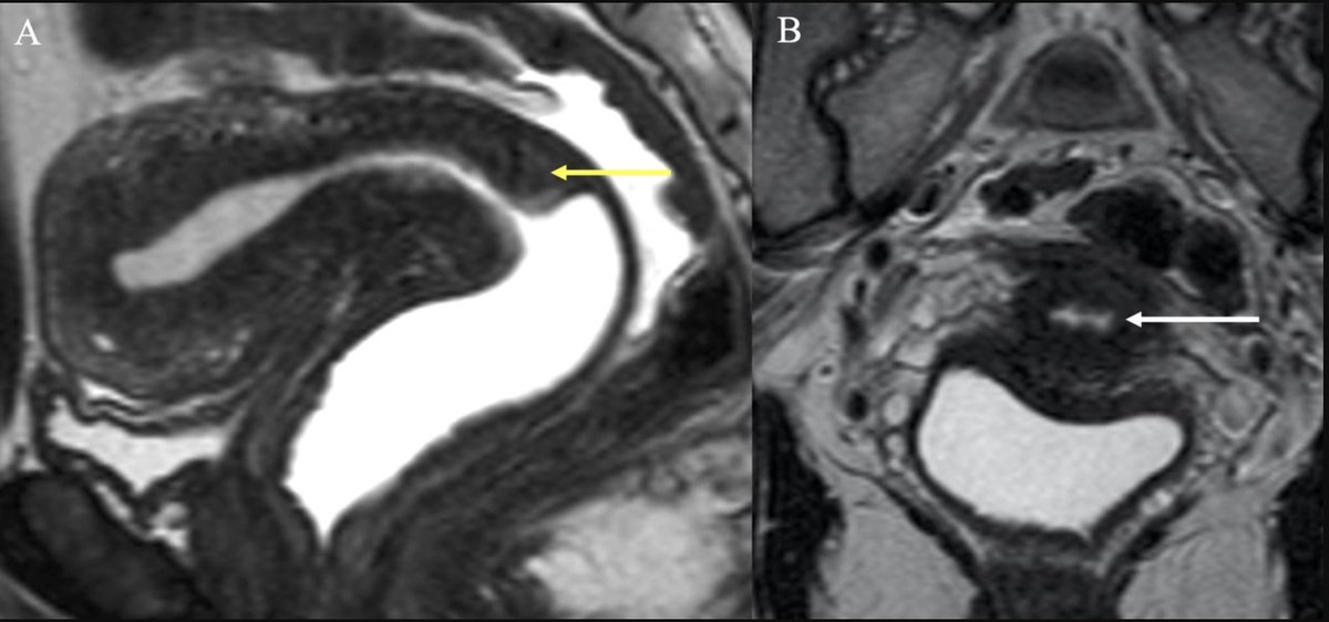 IJGConline's tweet photo. #CaseStudy
"#Infection versus #cancer: management of actinomyces mimicking #CervicalCancer or #OvarianCancer"
https://t.co/UVmWwzznCs
#GYNoncology #Education @GynMe4 @IJGCfellows @pedroramirezMD @AcadPathol @InfectDisNews @ImperialInfect https://t.co/N1sbKy9aV8